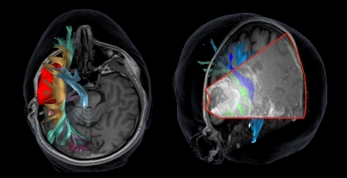 Two images, one an axial MRI slice with colourful DTI imaging superimposed, showing an example tumour in red, and other nerve tracts in blue, yellow, green and purple. The second image is a conronal MRI slice with superimposed colourful DTI, showing nerve tracts which has also had navigated ultrasound fused, showing how the brain appears through ultrasound imaging, including the DTI colours