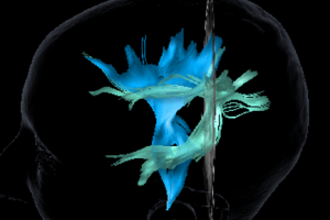 Sagittal image of a head, showing blue and green nerve tracts from a DTI scan